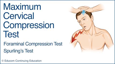 Maximum Cervical Compression Test (Spurling’s Test) 